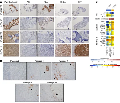 Figure 2. Disease progression is a continuum in mCRPC specimens. (A) IHC of different mCRPC sites from patient 13-084