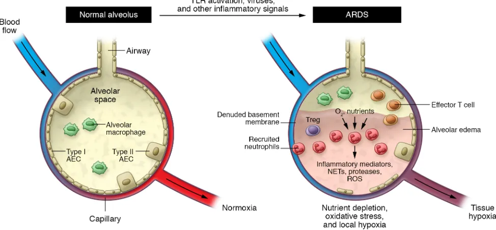Figure 3. Metabolic features of the tissue-damaged environment. Acute lung injury and its clinical correlate the acute respiratory distress syndrome (ARDS) represent a prototypical tissue-damaged environment