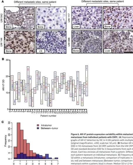 Figure 6. AR-V7 protein expression variability within metastasis and between metastases from individual patients with CRPC
