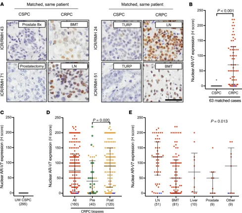 Figure 3. AR-V7 protein expression in PC. (A) Representative micrographs of AR-V7 detection by IHC in 4 ICR/RMH patients with matched CSPC and CRPC biopsies (original magnification, ×200; scale bar: 50 μm)