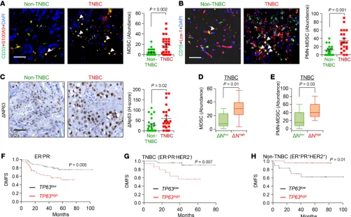 Figure 1. TNBC contains higher MDSC infiltration and high expression of Δhuman patients.Np63, which is associated with reduced distant metastasis–free survival of  (A and B) Representative immunofluorescence (IF) images (left) and calculated abundance (right) for CD33 and S100A9 (A) and CD15 and 