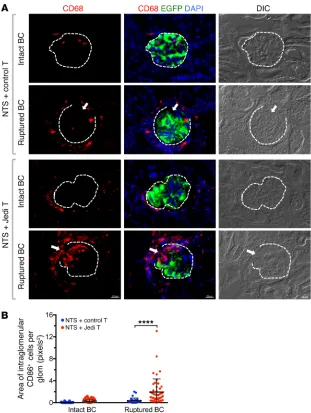 Figure 5. Effects of BC rupture on glomerular local-ization of CD68 macrophages. (A) Representative immunostained images of CD68+ macrophages in glomeruli with intact versus ruptured BC