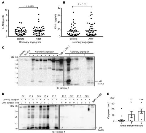 Figure 11. Inflammasome-related biomarkers are detected in human urine following contrast administration