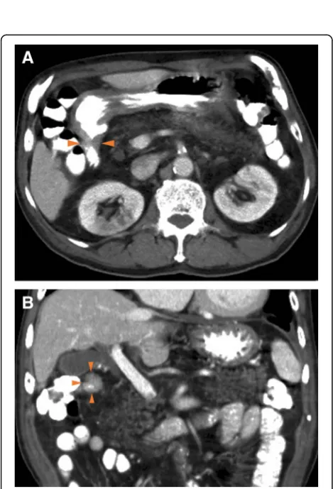 Fig. 1 Esophagogastroduodenoscopy showing the obstruction atthe first part of the duodenum