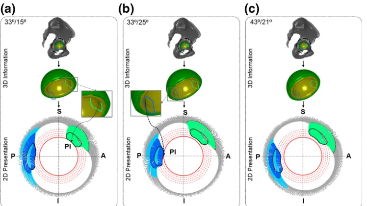 FIGURE 5.Results from Case Study II to show the effect of cup position on PI. (a), (b) and (c) show the 2D representation of 3D
