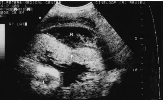 Fig.1. pre placental collection P-placenta, C- collection 