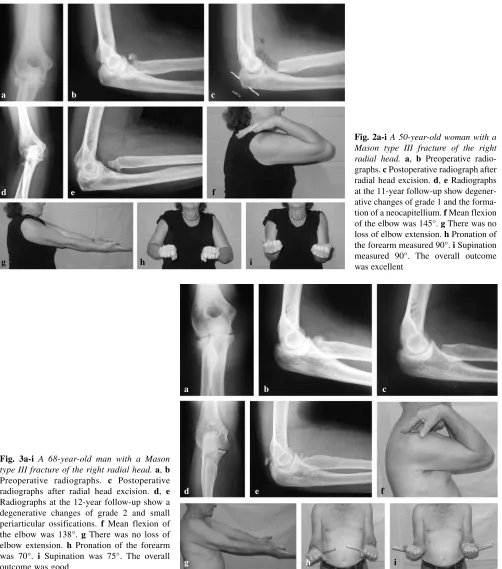 Fig. 3a-i A 68-year-old man with a Masonradiographs after radial head excision. Preoperative radiographs