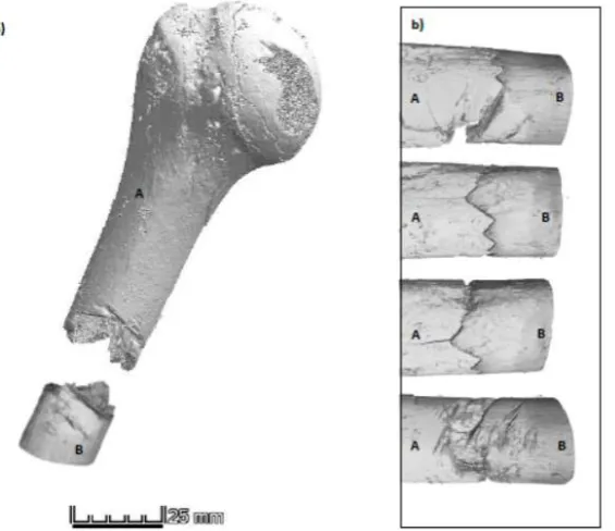 Figure 6: a) CT scan of proximal left humerus (A) from charred lump and segment recovered from suitcase 2 (B)