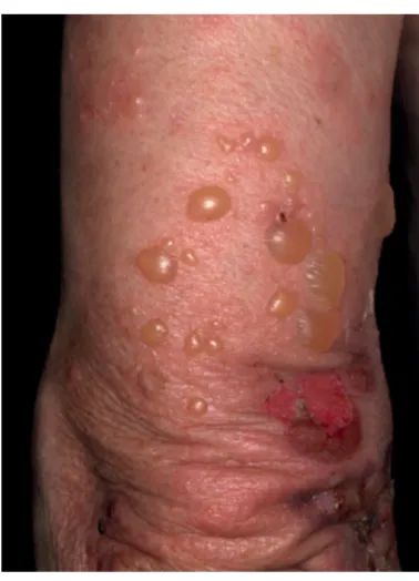 FIGURE 1 Large tense blisters and erosions in a man with BP (by kind permission of Professor Enno Schmidtwith written consent from the patient).