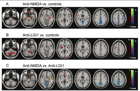 Figure 2 and an extent threshold of 30 voxels) hypermetabolism and hypometabolism in different brain regions of investigated patients with anti-N-methyl-D-aspartate receptor encephalitis (A, anti-NMDA, n = 6) and anti-leucine rich glioma inactivated 1 prot