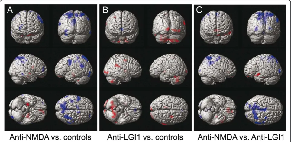 Figure 3 18F-fluoro-2-deoxy-d-glucose positron emission tomography in patients with anti-N-methyl-D-aspartate receptor andanti-leucine rich glioma inactivated 1 protein encephalitis – projection onto surface display