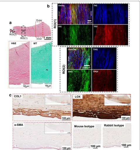 Fig. 2 Histological and NLO microscopy images of capsule with Baker grade 3 (example 2)
