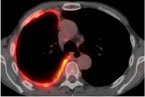 Fig. 3 Integrated CT-PET in patient with malignant pleural meso-thelioma showing diffuse uptake of FDG in right pleural tumor