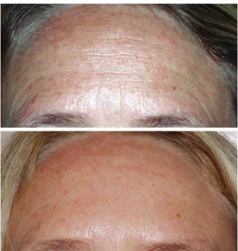 Fig. 6. A 47-year-old woman with wrinkles of the forehead pre- pre-operatively (above) and 1 year postpre-operatively (below).