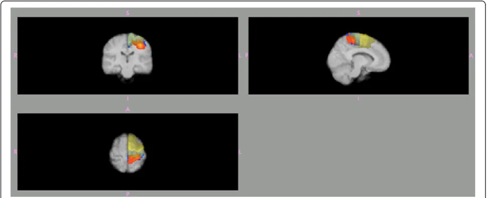 Figure 1 Automatic definition of 3 Brodmann areas (BA) within the left hemisphere according to the Jülich probability atlas BA4a (blue), BA4p(orange) and BA6 (yellow)