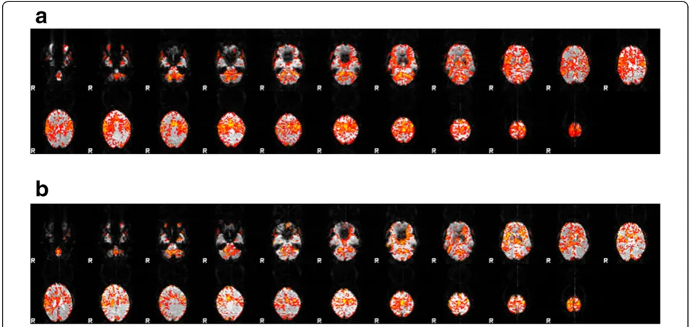 Figure 3 The mean BOLD activity is shown before (a) and 12 weeks after (b) intervention in stroke patient #1