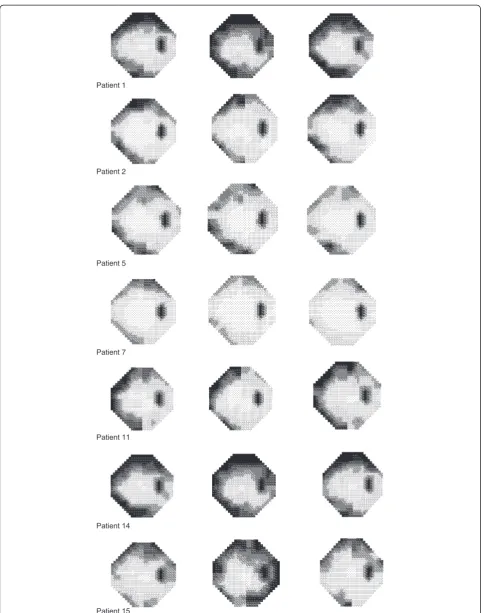 Figure 3 Grey Scale plots for all patients with a VGB attributed visual field defect: left Full Threshold, middle SITA Standard, right SITA Fast.