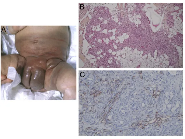 FIGURE 5Tufted angioma. A, Red vascular lesion with leathery quality on the arm of an infant