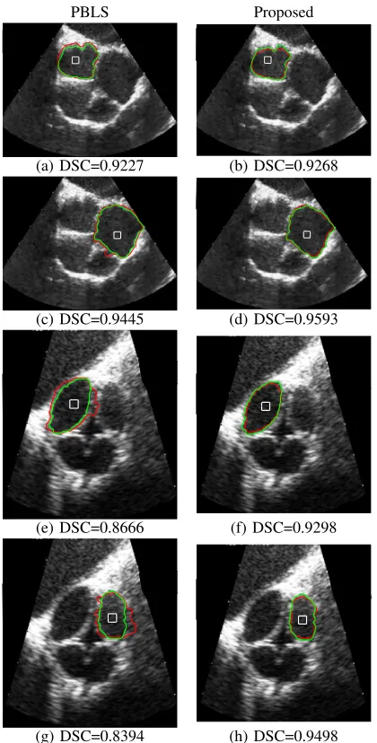 Fig. 11. Visual results and DSC values attained by PBLS and the proposedmethod in ultra sound images of the heart