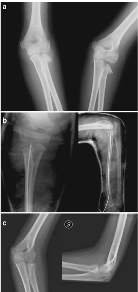 Fig. 1 a Radial neck fracture Judet type III. b Osteosynthesis withESIN, postoperative X-rays