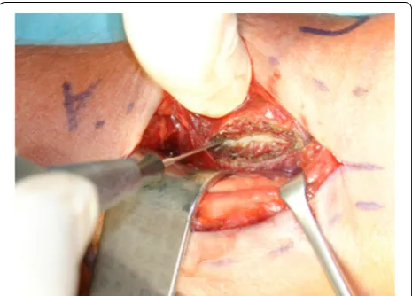 Fig. 1 Incision of the PQ muscle at the radial third of the distal radius
