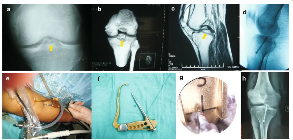 Fig. 1 PCL avulsion fracture of a 26-year-old male was fixed anteriorly under arthroscopy with one partially threaded cannulated screws