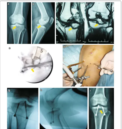 Fig. 2 PCL avulsion fracture of a 32-year-old female was fixed anteriorly under arthroscopy with two partially threaded cannulated screws
