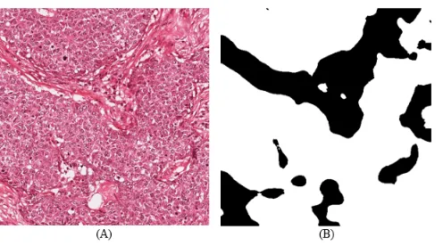 Fig. 4. Example of the original breast cancer image (A) and the predicted one (B) 