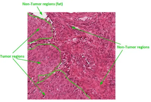Fig. 3. Breast cancer image segmentation [16] 