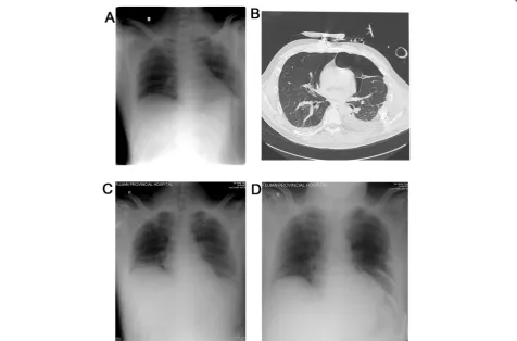 Fig. 1 astabilization of ribs 3pancreatitis, rupture of the spleen.–b Fifty-five-year-old patient (the surgery group) sustaining anterolateral flail chest due to segmental fracture of ribs 4–9, hematopneumothorax, c Endotracheal intubation and insertion of