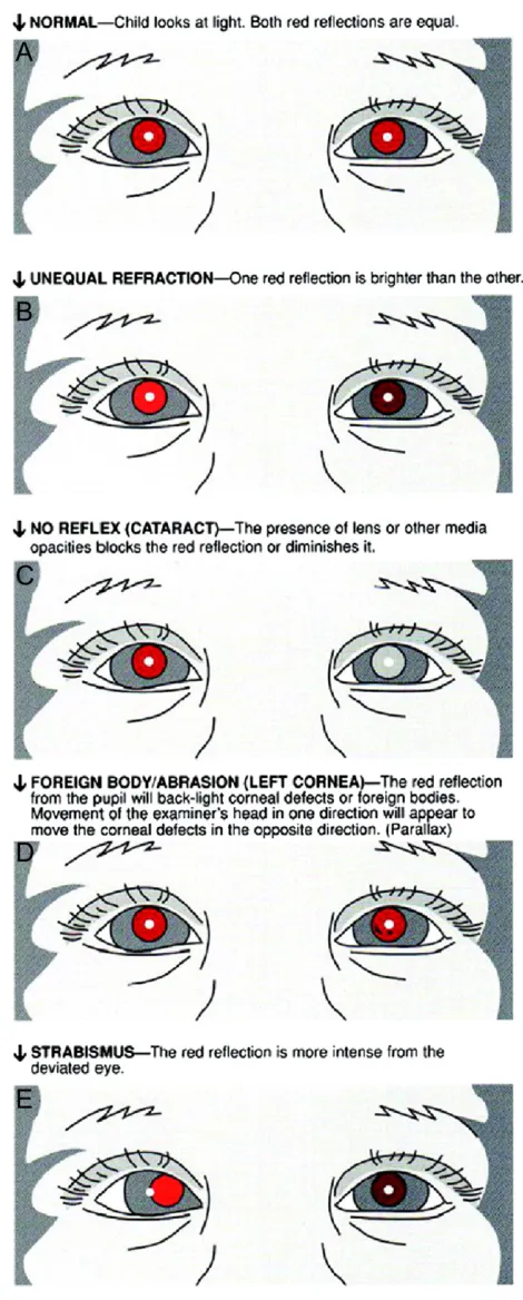 FIGURE 1Red reREFRACTION:foreign bodies. Movement of the examinerdefects in the opposite direction