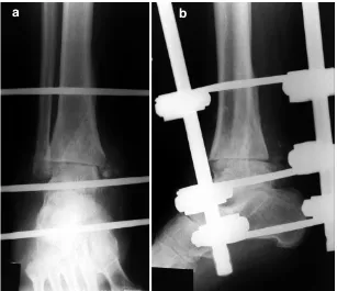 Fig. 1. External fixator applied in a slightly triangular fashion,compression is applied between distal tibial and talar Stein-mann-nail.