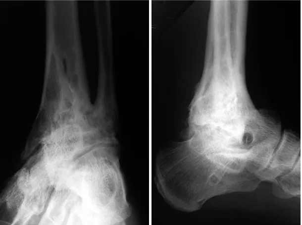 Fig. 3. Radiographs of a 42 year old malepatient 98 months after arthrodesis. Thereare signs of subtalar arthrosis, the Kitaokascore was 62.