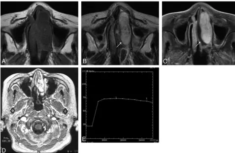 FIG 1. Woman, 74 years old. A, Axial T1-weighted MR imaging shows a homogeneous isointense signal mass in the left nasal cavity
