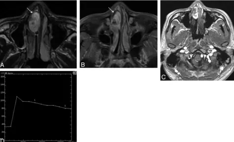 FIG 3. Man, 44 years old.signal mass in the left nasal cavity with patchy high signal area ( A, Axial T1-weighted MR imaging shows a heterogeneously isointensem), corresponding to hemorrhage.B, Lesion shows heterogeneously hyperintense on axial T2-weighted MR imaging with multipleﬂow voids (,).