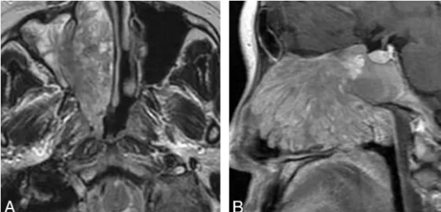 FIG 4. Woman, 56 years old.shows a characteristic “cerebriform” appearance on sagittal enhanced T1-weighted MR imaging A, Axial T2-weighted MR imaging shows a heterogeneously isoin-tense signal mass in the right nasal cavity with associated obstructive max