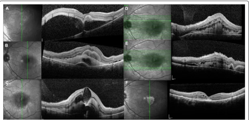 Fig. 1 OCT findings in the acute and final phase of the disease. a Optical coherence tomography (OCT) at baseline showing a large serouselevation of the neurosensory retina in the macular area with central highly reflective sub-retinal material
