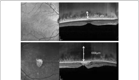 Fig. 5 OCT after delivery. Inverted images acquired to measure the choroidal thickness show significant choroidal thickening in the left eye