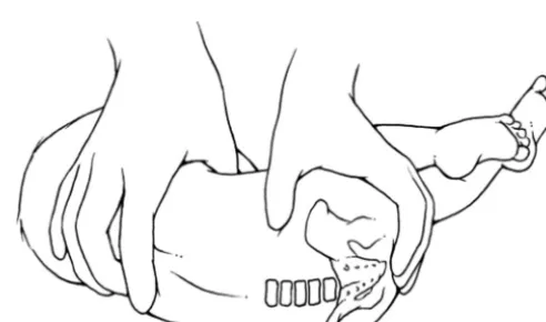 FIGURE 1Lateral recumbent position.