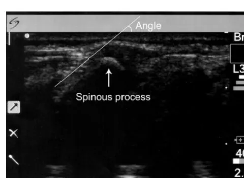 FIGURE 4Sample image showing spinous processes.