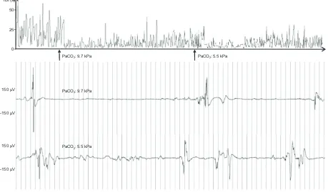 FIGURE 2Upper, IBI trend during 5 hours in an infant born at 24 gestational weeks. Lower, Two EEG tracings (duration: 64 seconds)