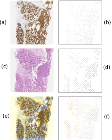 Figure 8. A demonstration of the nuclei cluster detection on two breast tissue slides