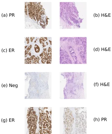 Figure 2. Examples of pairs of registered visual fields for a variety of stain types. Figure 2a,b shows the registration of an PR slide to an H&E slide