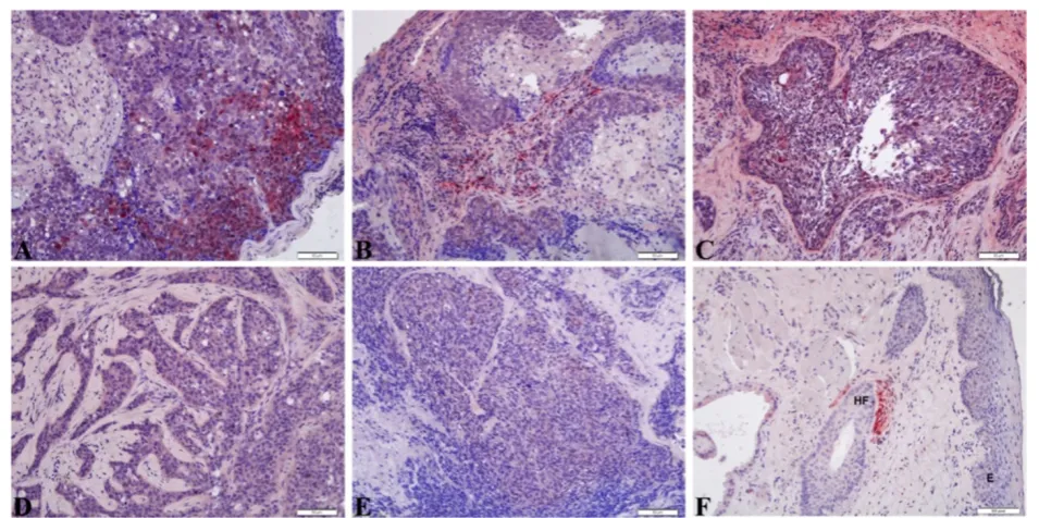 Fig. 3 Immunohistochemistry shows varying expression of CRABP1 in sebaceous cell carcinoma