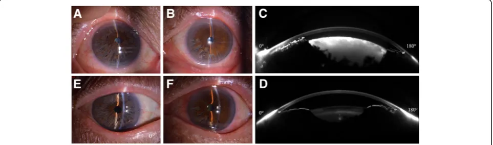 Fig. 1 Slit-lamp photographs and Scheimpflug images by Sirius of case 1.similar to preoperative status and an AC of normal depth were observed in the right eye.observed