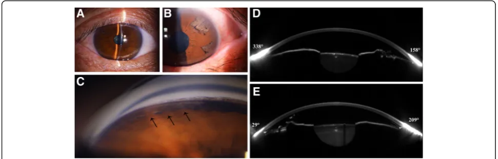 Fig. 3 Slit-lamp photographs, gonioscopy and the Scheimpflug images by Sirius of the patient in case 3.temporal quadrant of the iris was observed.anterior chamber in the superior area of the right eye had discontinuous synechiae together with pigment depos