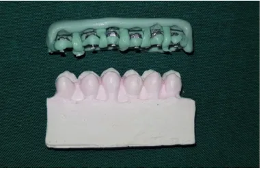 Fig  22. Light curing of the 7th generation conventional lingual brackets with the adhesive 