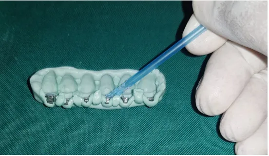 Fig 27. Application of etchant on the natural teeth 