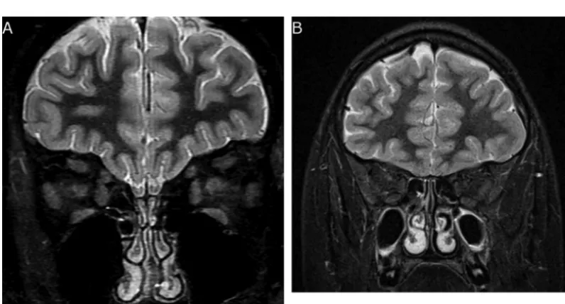 FIGURE 2Brain MRI of olfactory bulbs. A, Normal brain MRI with present olfactory bulbs