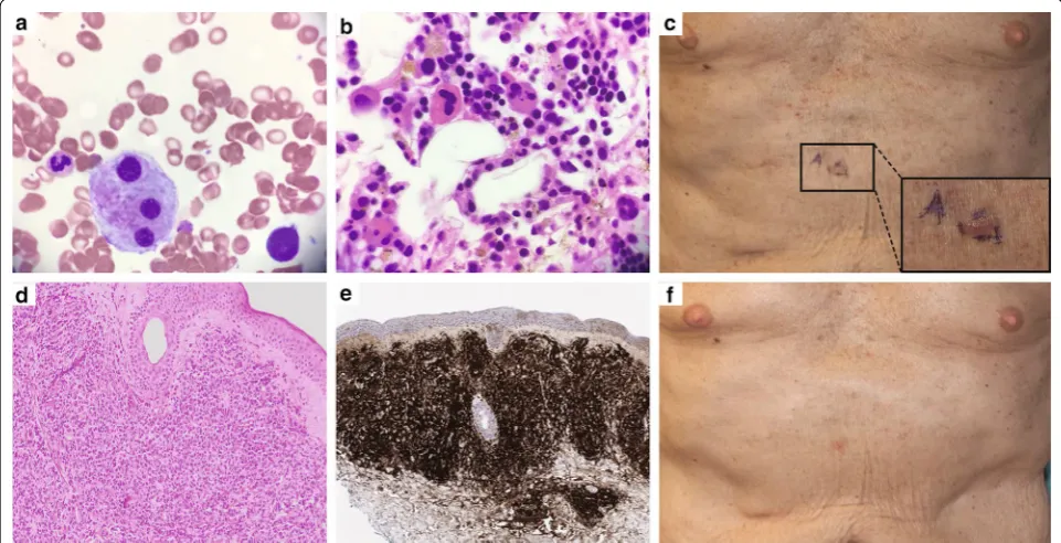 Fig. 1 Bone marrow at presentation (MDS) and skin lesions after transformation (BPDCN)
